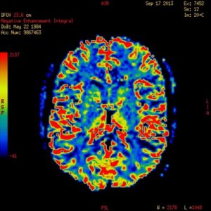 мозок на МРТ - фото