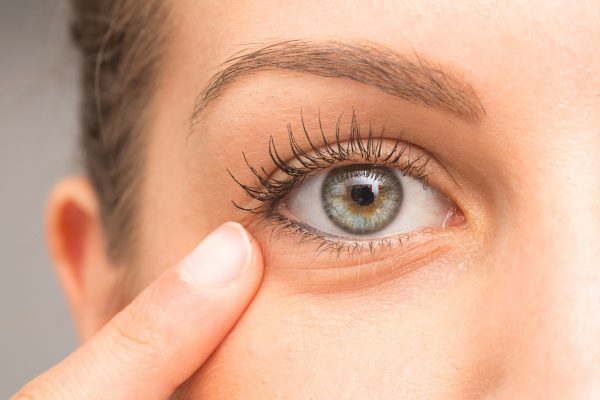 Как убрать «гусиные лапки» вокруг глаз?