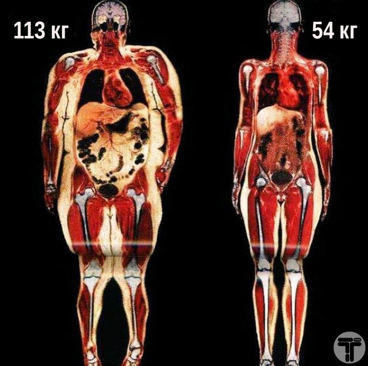 Как выглядит человек с лишним весом, и как выглядит с нормальным.