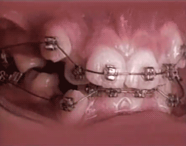 Ускоренный процесс выравнивания зубом с помощью брекетов.