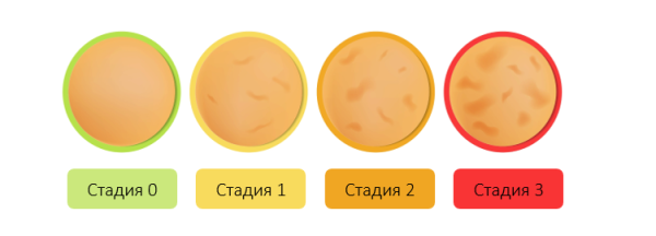 целлюлит: стадии стадии целлюлита